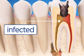Maybe you would like to learn more about one of these? Do I Need A Root Canal True Dental Odenton Maryland