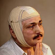 L'accident d'irradiation à Forbach (1991)