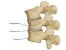 Images correspondant compression fracture of the spine