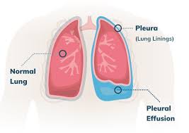 These fibers get lodged into the protective lining of the lungs (the pleura), . Pleural Effusion Mesothelioma Causes Signs Treatments