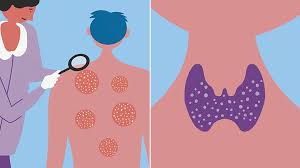 A family history of thyroid disease or cancer magnifies the threat. How Psoriasis And Your Thyroid May Be Linked Everyday Health