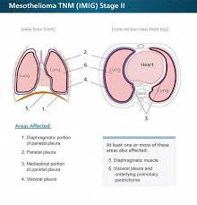 Mesothelioma Stages Staging Systems What Your Stage Means