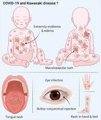 Jul 17, 2020 · she also showed symptoms suggestive of kawasaki, such as pink eye, cracked lips, swollen hands and feet, redness on the palms of her hands, a large rash and swollen lymph nodes. The Natural History Pathobiology And Clinical Manifestations Of Sars Cov 2 Infections Springerlink