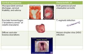 Image result for Friable Cervix