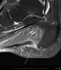 It is a long, thin and variably developed muscle which runs from the femur to the achilles tendon. Plantar Fascial Medial Band Rupture Radiology Case Radiopaedia Org