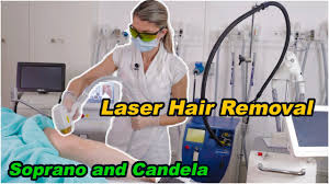 Laser Hair Removal Using Soprano Ice Platinum Laser Candela Laser Best Hair Removal In 2021 Youtube