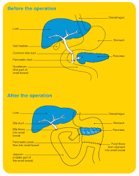 The most common type of pancreatic cancer starts in the cells that produce digestive juices and is called an exocrine tumour. Treatment Options Australian Pancreatic Cancer Genome Initiative