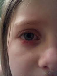 How To Get Rid Of Styes 1 Cup Orange Juice And One Table Spoon Of Cream Of Tarter Take Once Ever Health And Beauty Tips How To Stay Healthy Health And Beauty