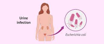 Urinary Tract Infections & Sexual Intercourse