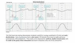Image result for Late Deceleration