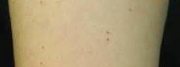 How To Treat Pinpoint Petechiae: 21 Natural Home Remedies