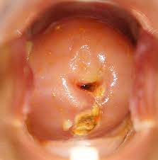 Escharotic Treatment Case Studies Treatment For Cervical Dysplasia Dr Nick Leroy