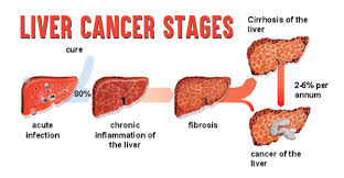 No cancer cells are present in deeper layers of tissue, nearby structures, lymph nodes or distant sites (carcinoma in situ). Liver Cancer Stages How Stages Of Lung Cancer Are Determined
