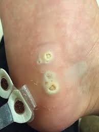 How To Remove Plantar Warts Naturally Artsea Chic Planter Warts Remedies Warts Honey Face Cleanser