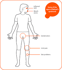 Behcet S Disease Patients Respond To Corticosteroids Use Aza Cyclophosphamide Colchicine Or Thalidomide To Wean Them Behcets Behcets Disease Skin Problems