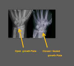 When And Why The Growth Epiphyseal Plates Close Gtwsl