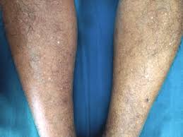 Image result for Pigment stains on the shin