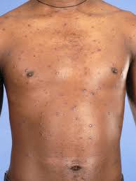 We did not find results for: Syfilis Syphilis Lues Soa