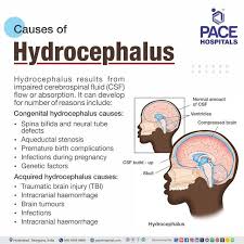 Image result for Hydrocephalus