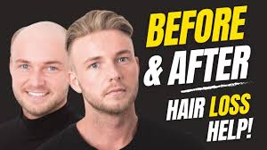 How to Apply (Attach) a Non-Surgical Hair Replacement System for Men with  The Harris Brothers UK/USA