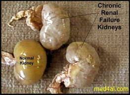 Associated with focal segmental glomerulosclerosis, a cause of nephrotic. Chronic Renal Failure Causes Clinical Picture And Complications