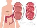 Syndrome du clon irritable - Causes, Symptmes, Diagnostic