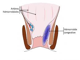 Bonjour à tous.je suis un homme et j'ai 40 ans. Traitement Des Hemorroides A Lyon Centre De Chirurgie Digestive