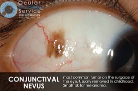 Image result for conjunctival melanoma