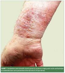 Maybe you would like to learn more about one of these? Toxicodendron Contact Dermatitis A Case Report And Brief Review Jcad The Journal Of Clinical And Aesthetic Dermatology
