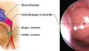 bebeklerde geniz eti