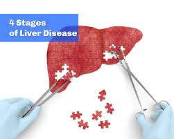 If liver cancer is diagnosed, the specialist will consider treatment options. What Are The Four Stages Of Liver Disease Walkin Lab