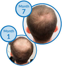 Best organic hair growth oils guaranteed. Is Prince Harry Using Caviar Hair Growth Supplements