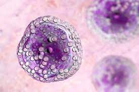 Non Hodgkin Lymphom Symptome Lebenserwartung
