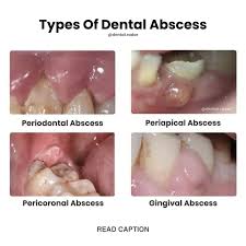 Image result for Periodontal Abscess