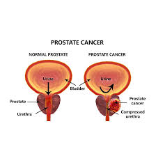 They also do tests to le. Prostate Cancer Diagnosis Treatment La Plata Urologist