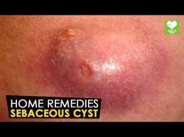Sebaceous Cyst Home Remedies Health Tone Tips Epidermoid Cyst Cyst Sebaceous Cysts