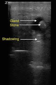 Image result for Sialolithiasis