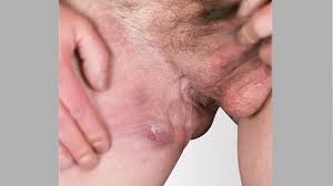 She also had an ulcer on the inside of her lip at the time but. Hs Symptoms Pictures No Bs About Hs