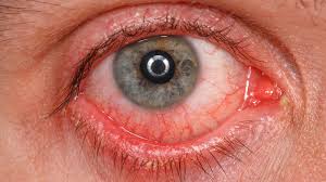 Coronavirus Update Pink Eye Could Be Rare Symptom Of Covd 19 Doctors Say Abc7 Los Angeles