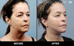 Prices include state taxes, installation and a one year. Toronto Neck Lift Chin Lift Toronto Plastic Surgeons