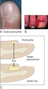 Image result for paronychium