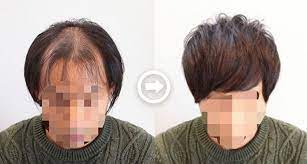 m字ハゲを自然に隠す髪型16選 男の薄毛を熟知した美容師のヘアカタログ aga エージーエープラス 薄毛ヘアスタイル 薄毛 はげ 髪型