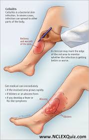 Nursing Study Guide Cellulitis Medical Surgical Nursing Surgical Nursing Wound Care Nursing