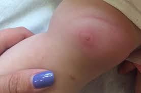This Mother S Life Saving Lyme Disease Warning Goes Viral