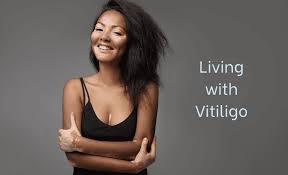 Image result for Vitiligo