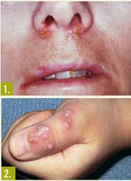 Pictures of herpes reveal a range of symptoms. A Collection Of Herpes Manifestations And Herpes Associated Syndromes Consultant360