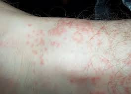 How Do You Treat Turkey Mite Bites