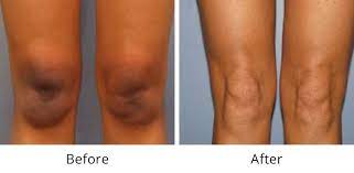 A spot test is an easy way to determine how your body will react to vaginal bleach. Intimate Lightening David Ghozland M D