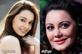 Top 10 Bollywood Plastic Surgeries Disasters Before After Heart Bows Makeup Indi Plastic Surgery Indian Makeup And Beauty Blog Makeup And Beauty Blog Minissha lamba most horrible nose surgery goes wrong check out the video to know more. top 10 bollywood plastic surgeries