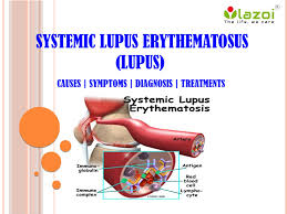 Learn more about the symptoms, complication, causes, types, diagnosis, treatment, lifestyle changes, and outlook for lupus. Systemic Lupus Erythematosus Lupus Disease Of The Immune System By Lazoithelife Issuu